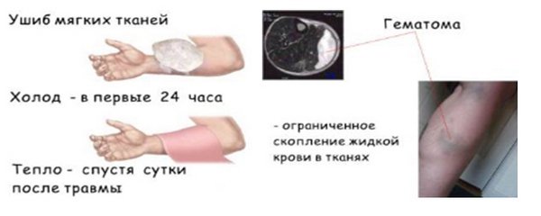 Первая помощь при ушибах. Симптомы и оказание правильной помощи