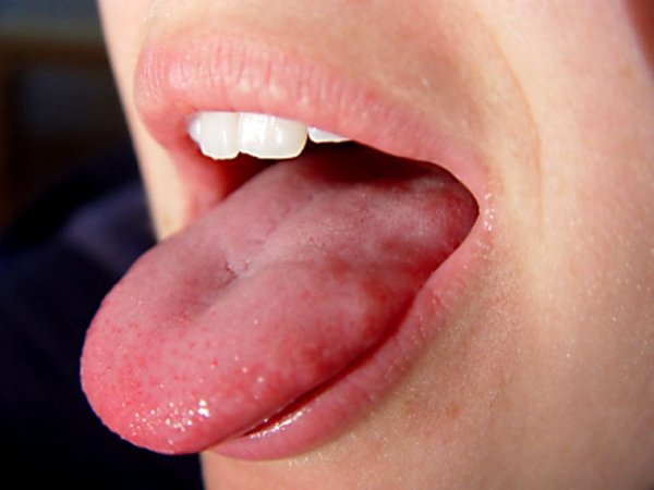 Почему немеет язык и болит голова