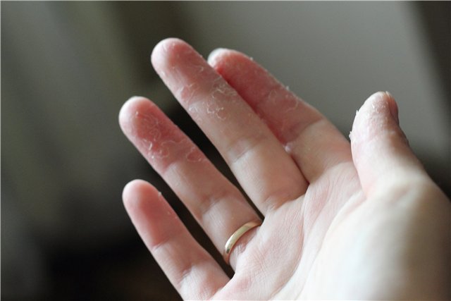 Лучшие средства для защиты кожи и лечения трещин на пальцах рук