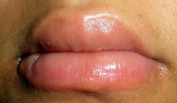 От аллергии опухли губы