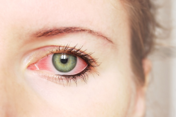 Как передается конъюнктивит глаз?