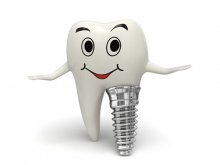 Имплантация зубов: преимущества, процедура, уход и альтернативы