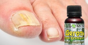 Березовый деготь в борьбе с грибком ногтей: обзор средства и методов лечения