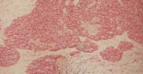 Пятнистый псориаз – самый распространённый тип заболевания