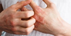 Что такое мокнущий дерматит и как от него избавиться?