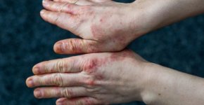 Почему дерматит появляется на руках и чем лечить?