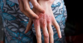 Особенности протекания и лечения псориаза на руках
