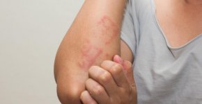 Контактный дерматит – реакция кожи на раздражитель или аллерген