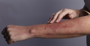 Как проявляется обострение атопического дерматита? Правила лечения и профилактики