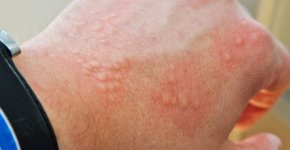 Фолликулярный дерматит: какие причины провоцируют заболевание и как его лечат