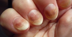 Грибок ногтей на руках и способы его лечения