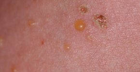 Буллезный дерматит – острое заболевание кожных покровов