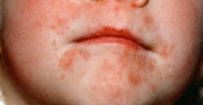 Почему возникает дерматит на губах и щеках? Как лечить?