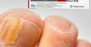 Лечение грибка ногтей средством "Акридерм"