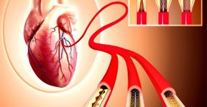 Коронарография сосудов сердца: о процедуре и ее важности