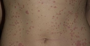 Каплевидный псориаз – кожное заболевание аутоиммунного характера