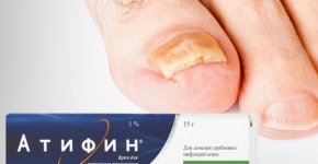 Лечение грибка ногтей средством "Атифин"