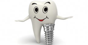 Имплантация зубов: преимущества, процедура, уход и альтернативы
