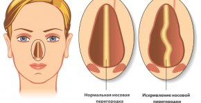 Симптомы и лечение искривления носовой перегородки