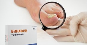Лечение грибка ногтей препаратом Бинафин