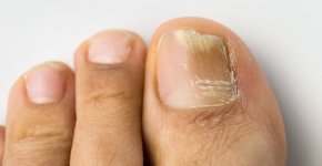 Почему появляется и чем лечить грибок ногтей на ногах?