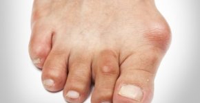 Что представляет собой артрит большого пальца стопы?