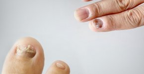 Онихомикоз: как распознать и вылечить грибок под ногтями?