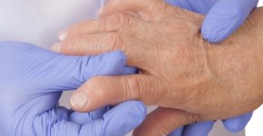Что такое артрит: как проявляется, чем лечить и как его предотвратить