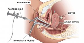 Гистероскопия матки — самый информационный метод диагностики