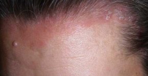 Что такое экзема кожи головы: особенности болезни у взрослых и детей