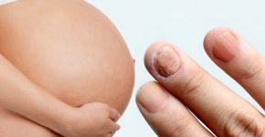 Онихомикоз (грибок ногтей) при беременности: симптомы и безопасное лечение