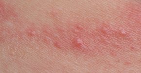 Что такое герпетический везикулярный дерматит?