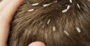 Вши в волосах (педикулёз): причины, лечение и профилактика