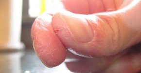 Почему трескается кожа на пальцах рук и что делать?
