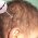 Веретенообразные волосы (монилетрикс)