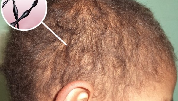 Веретенообразные волосы (монилетрикс)