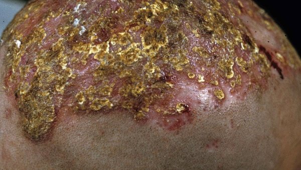 Фавус (парша) - кожная грибковая болезнь