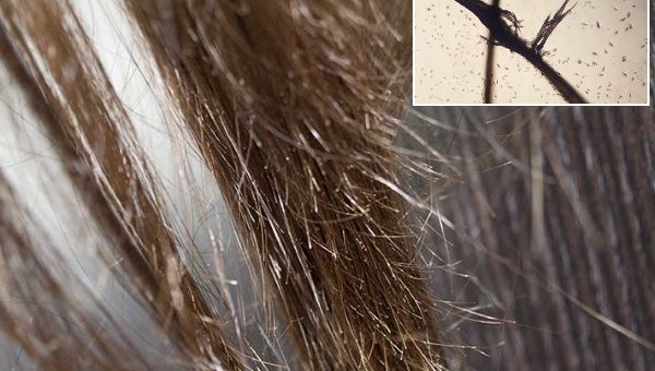 Особенности трихоклазии: причины появления, диагностика и лечение ломких волос