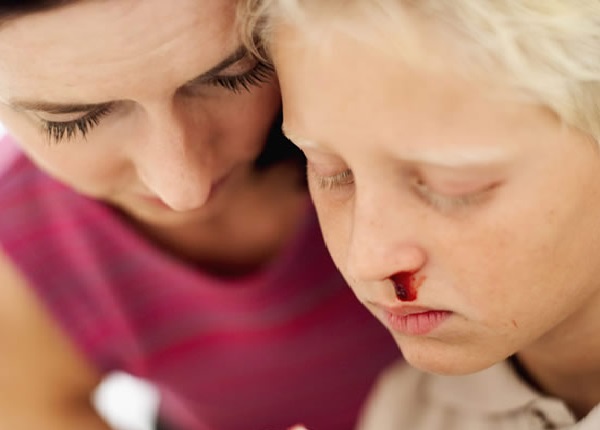 Носовое кровотечение у ребёнка