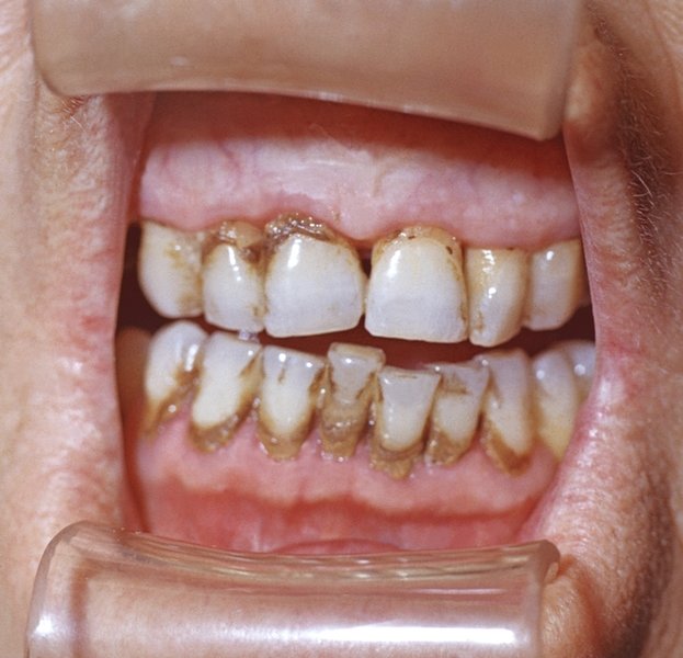 1 пример плотного отложения на поверхности зубов