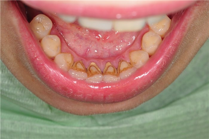 2 пример плотного отложения на поверхности зубов