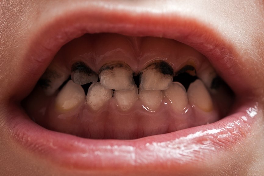 4 пример плотного отложения на поверхности зубов