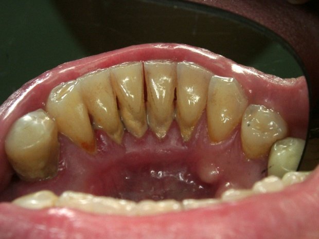 3 пример плотного отложения на поверхности зубов
