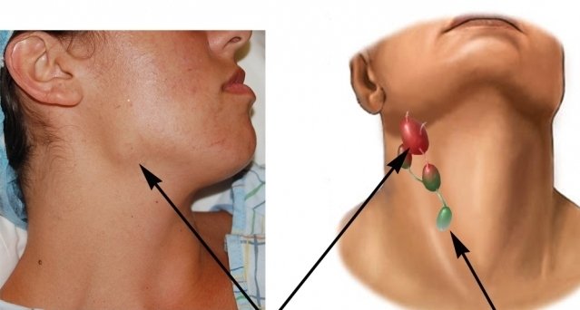 Симптомы воспаленных узлов на шее