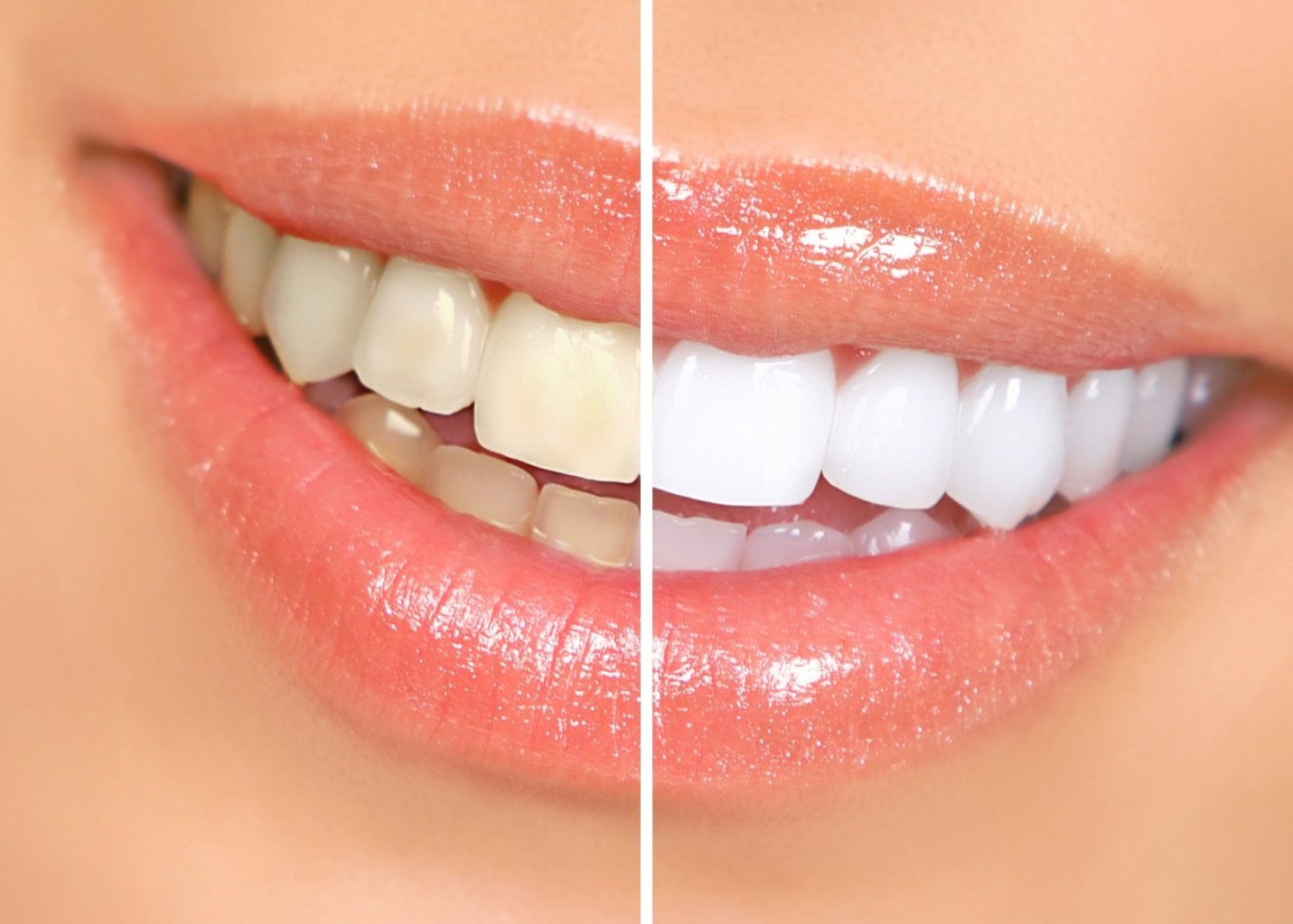 До и после отбеливание зубов