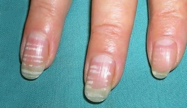 Белые пятна на ногтях рук