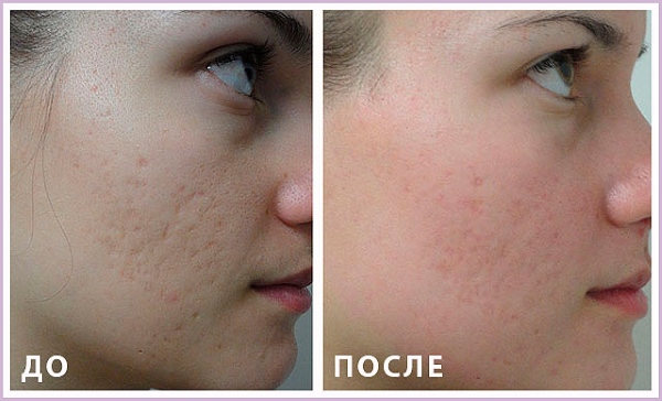 До и после шлифовки рубцов на лице