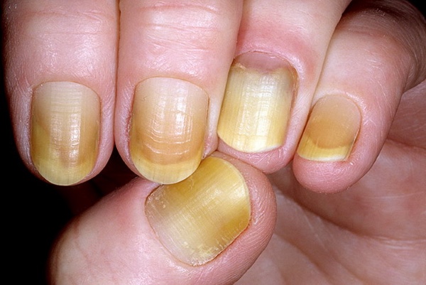 Желтые ногти из-за грибка