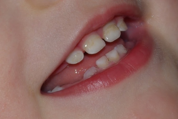 Пятна на зубах у ребенка при кариесе