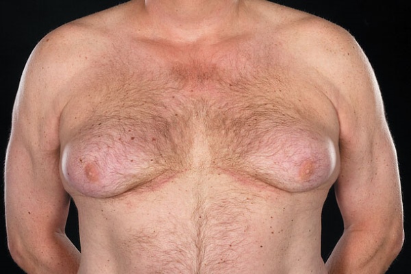 Увеличение груди у мужчин